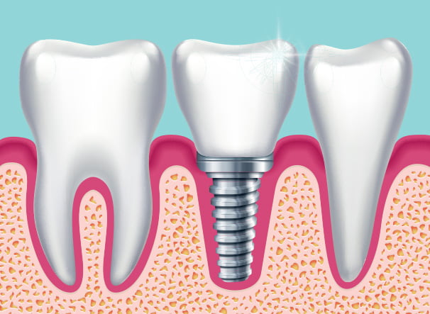 illustration of implants